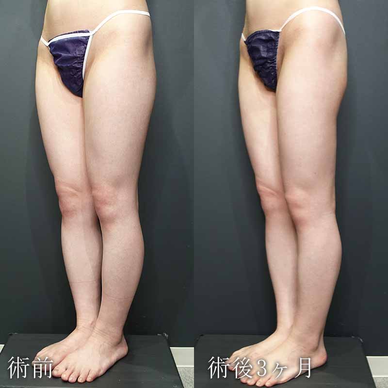20240116_G31109_takemura_thigh-liposuction_O_part P縦
