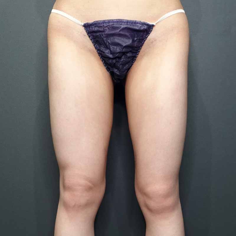 20240116_G31109_takemura_thigh-liposuction_O_part 追加写真①After