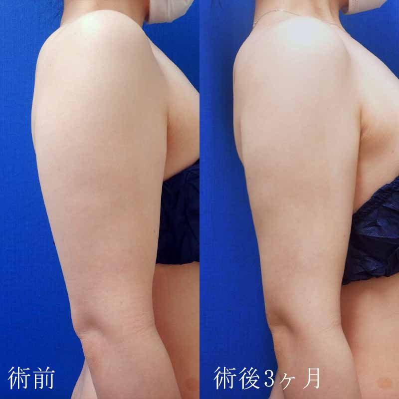 20240117_N35523_nishikawa_arm-liposuction_O_part P縦