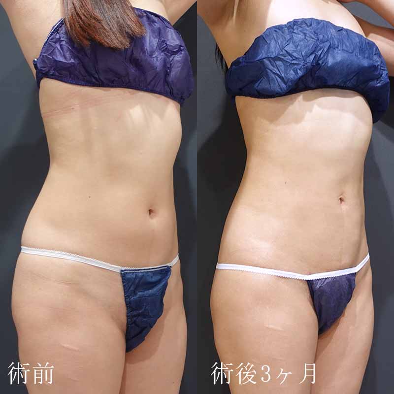 20240118_G11527_suzuki_stomach-liposuction P縦