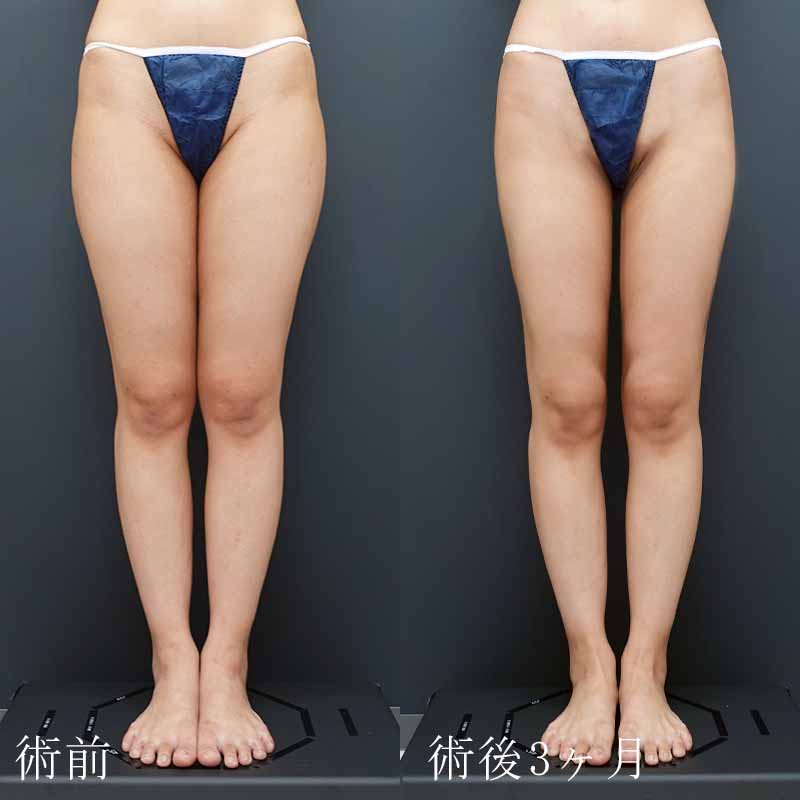 20240119_N22360_sato_thigh-liposuction P縦