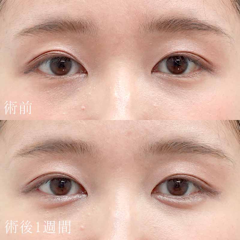 20240120_G36249_osada_hyaluronic eye bags01