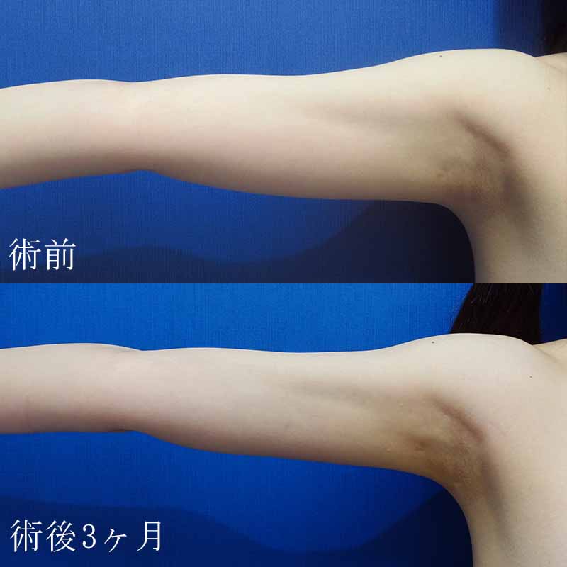 20240121_G15076_arm-liposuction