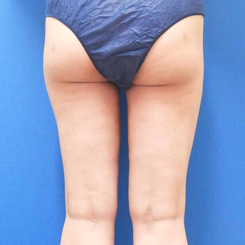 20240123_N33628_nishikawa_thigh-liposuction 追加写真①After
