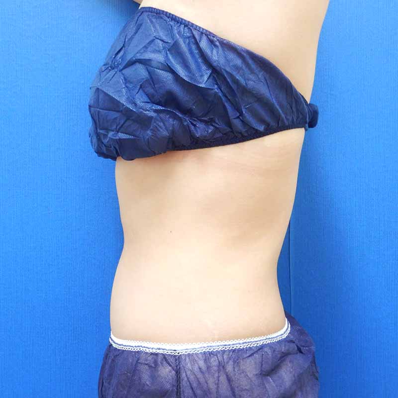 20240127_N24655_takemura_stomach-liposuction 追加写真①Before