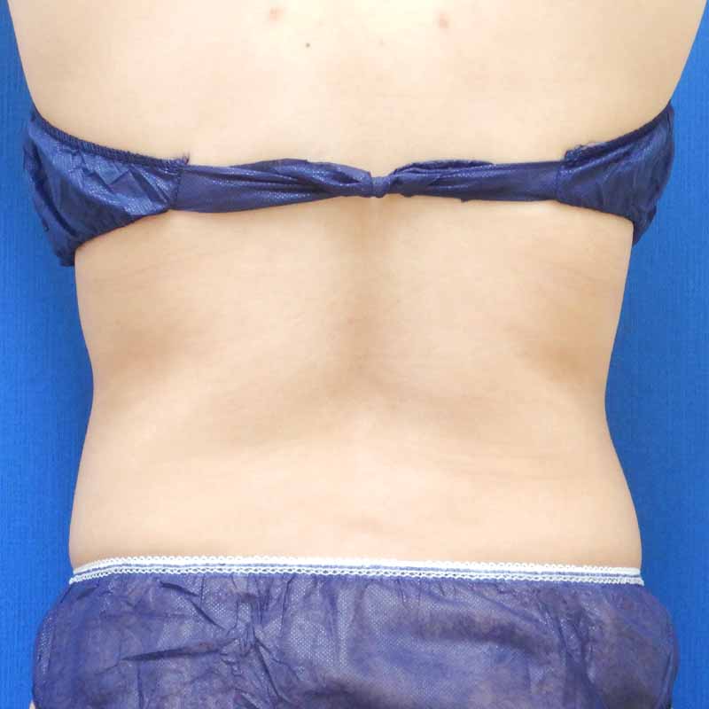 20240127_N24655_takemura_stomach-liposuction 追加写真②Before