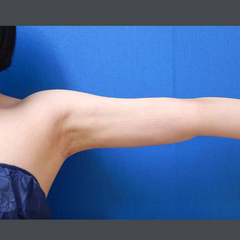 20240127_N35862_nishikawa_arm-liposuction_O_part 追加写真①After