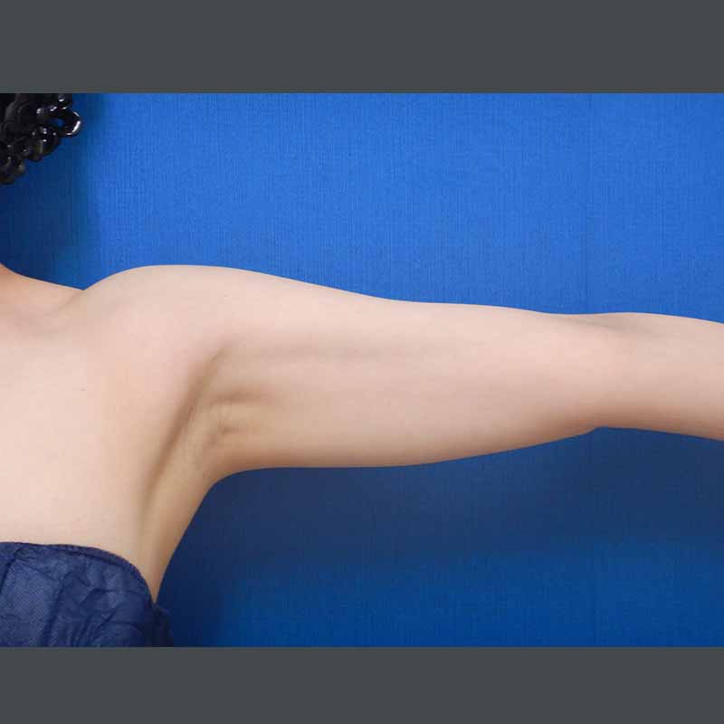 20240127_N35862_nishikawa_arm-liposuction_O_part 追加写真①Before