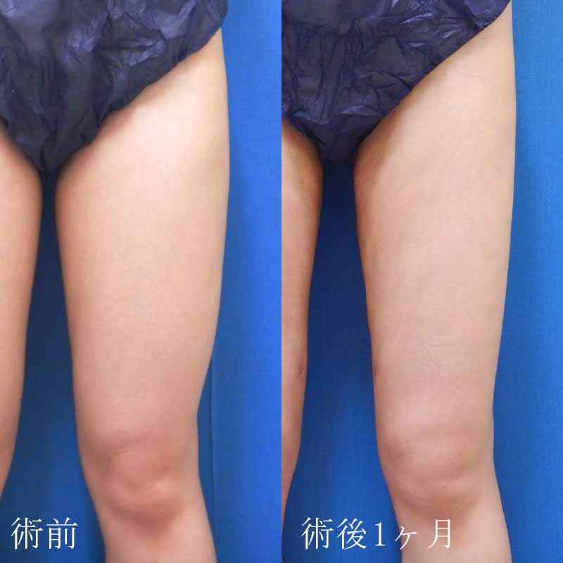 20240127_N37115_kaneko_thigh-liposuction P縦
