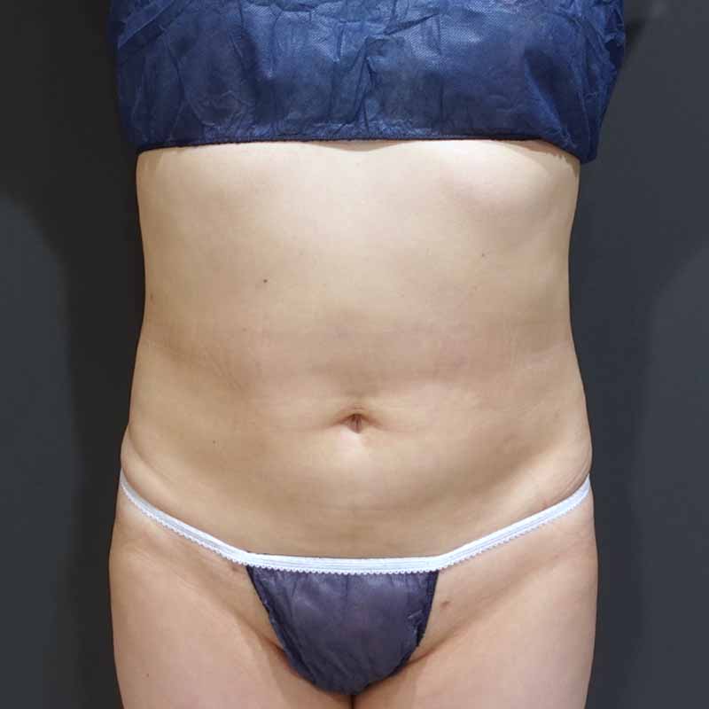 20240127_S22847_suzuki_stomach-liposuction_O_part 追加写真①After
