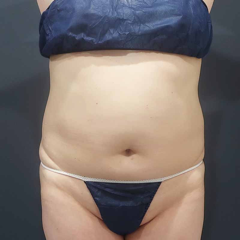 20240127_S22847_suzuki_stomach-liposuction_O_part 追加写真①Before