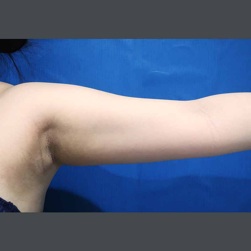 20240128_S17401_suzuki_arm-liposuction_O_part 追加写真①Before