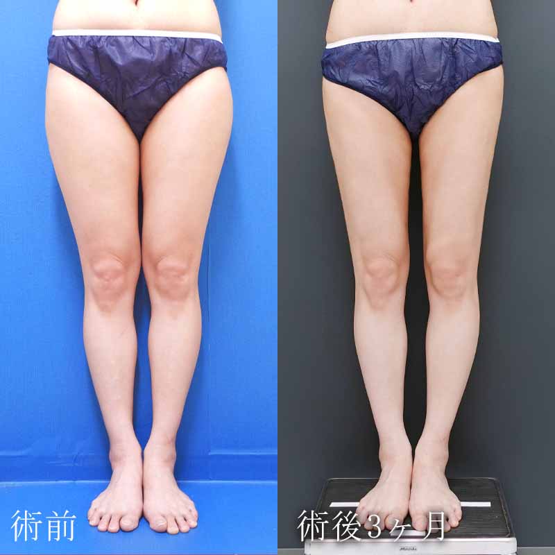 20240122_N27476_thigh-liposuction P縦