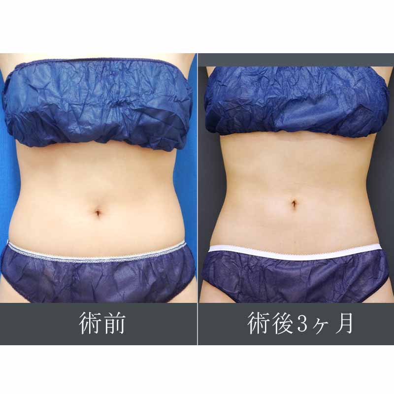 【上下白有】20240127_N24655_takemura_stomach-liposuction P縦