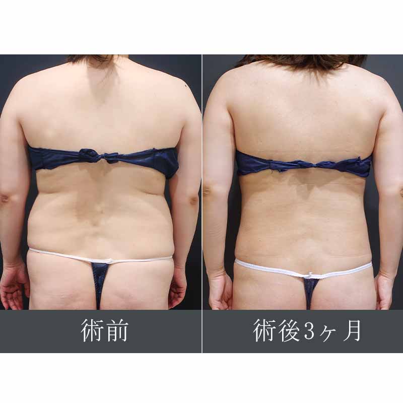 【上下白有】20240127_S22847_suzuki_stomach-liposuction_O_part P縦