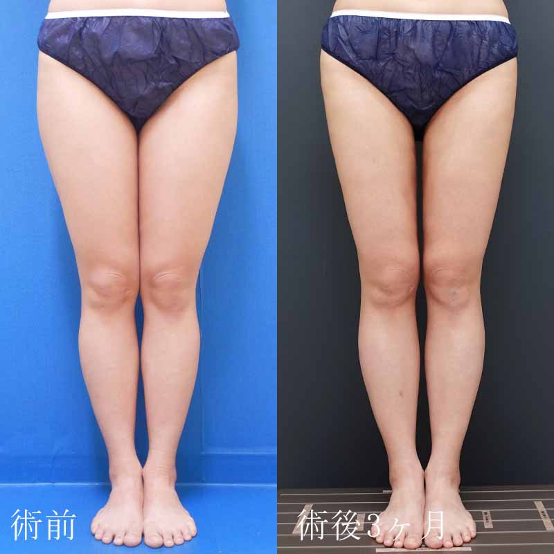 20240201_N38963_kaneko_thigh-liposuction_O_part P縦