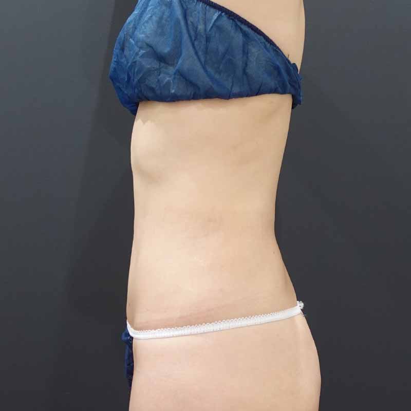 20240213_F2294_kaneko_stomach-liposuction_O_part 追加写真①After