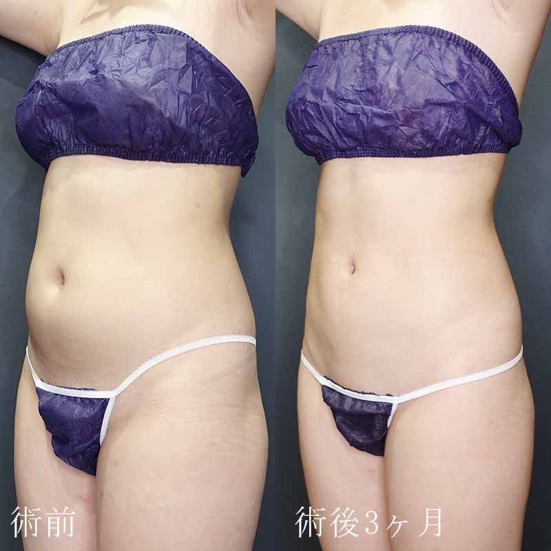 20240213_G32223_ishihara_stomach-liposuction P縦