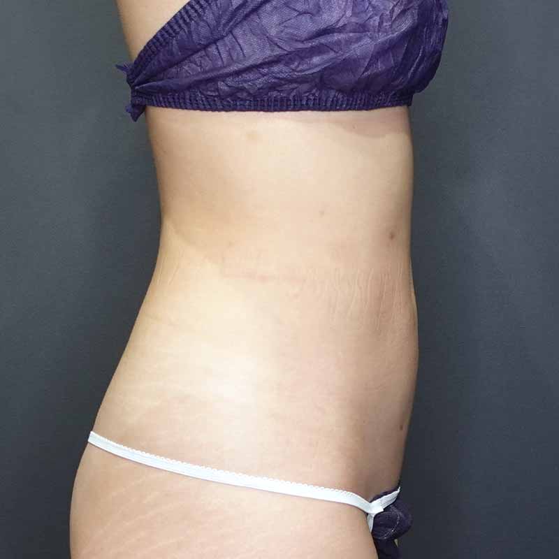 20240213_G32223_ishihara_stomach-liposuction 追加写真②After