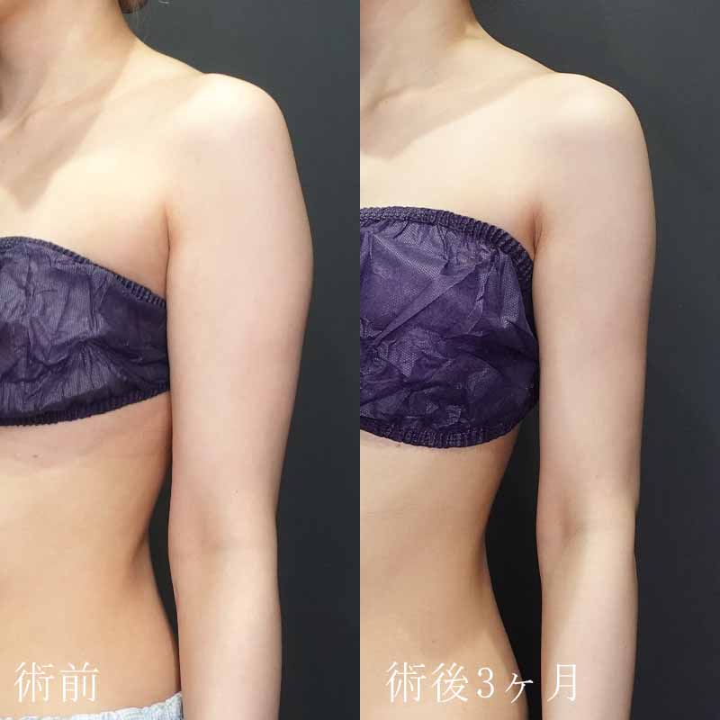 20240213_N29762_takemura_arm-liposuction P縦