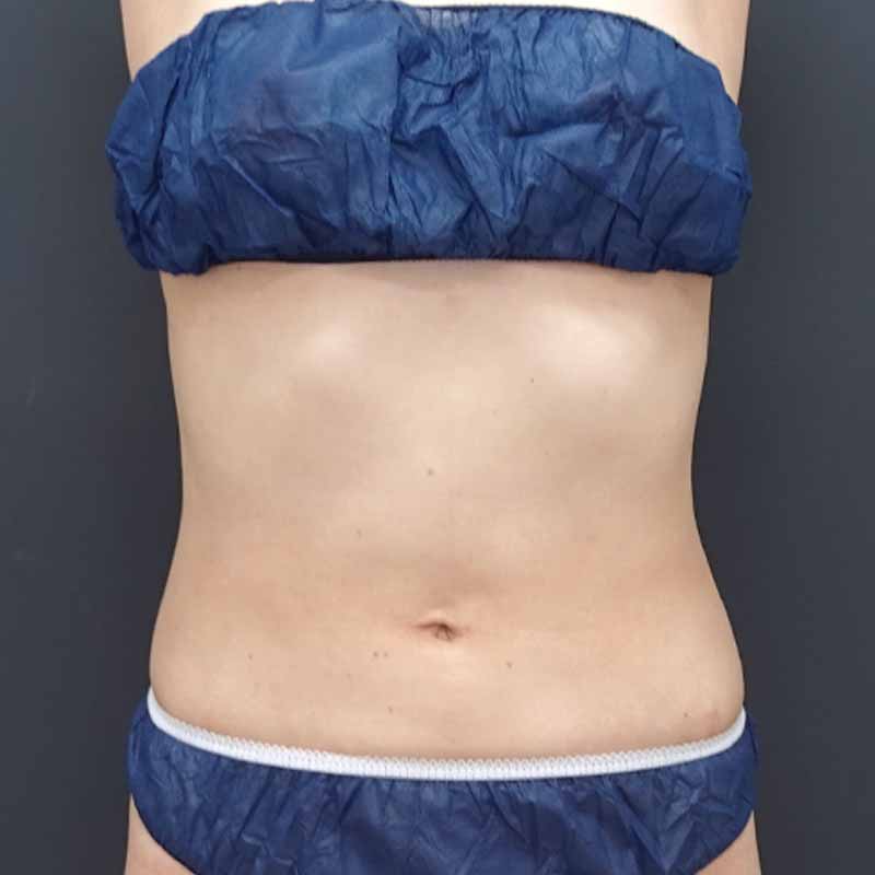 20240213_N41264_sato_stomach-liposuction 追加写真①After