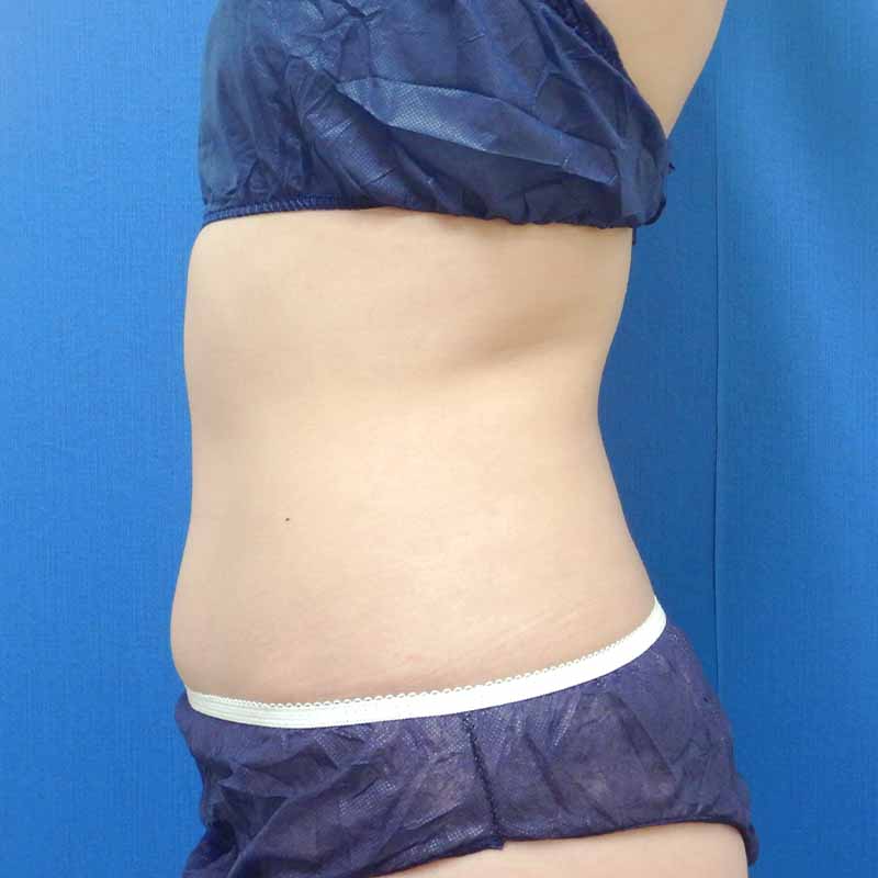 20240215_N37012_takemura_stomach-liposuction 追加写真①Before