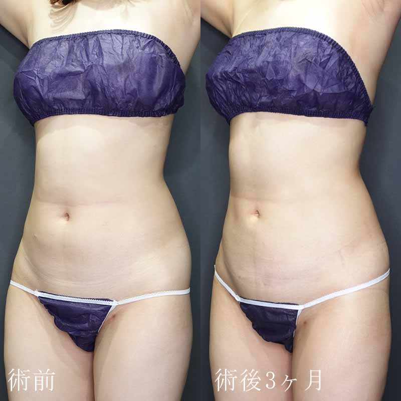 20240216_G32362_ishihara_stomach-liposuction P縦