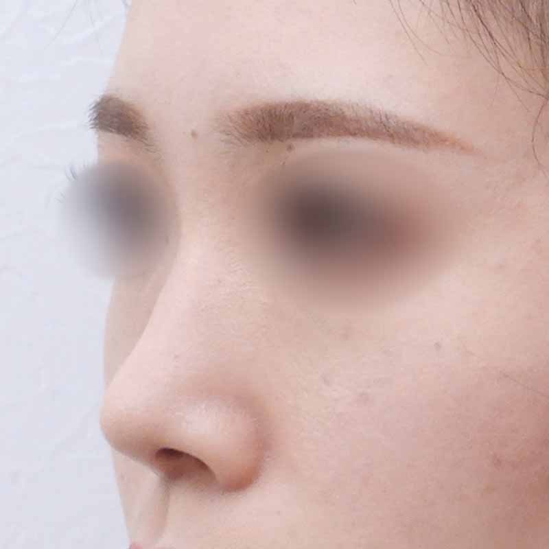鼻尖縮小＋耳介軟骨移植の症例写真 Ι 執刀医：西川 陽平 Ι 美容整形 
