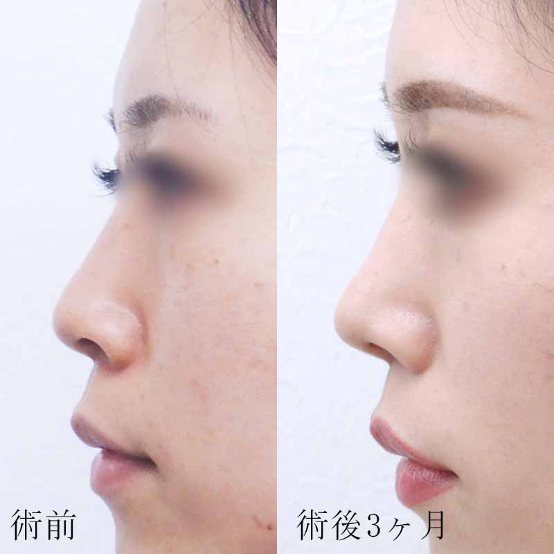 鼻尖縮小＋耳介軟骨移植の症例写真 Ι 執刀医：西川 陽平 Ι 美容整形 