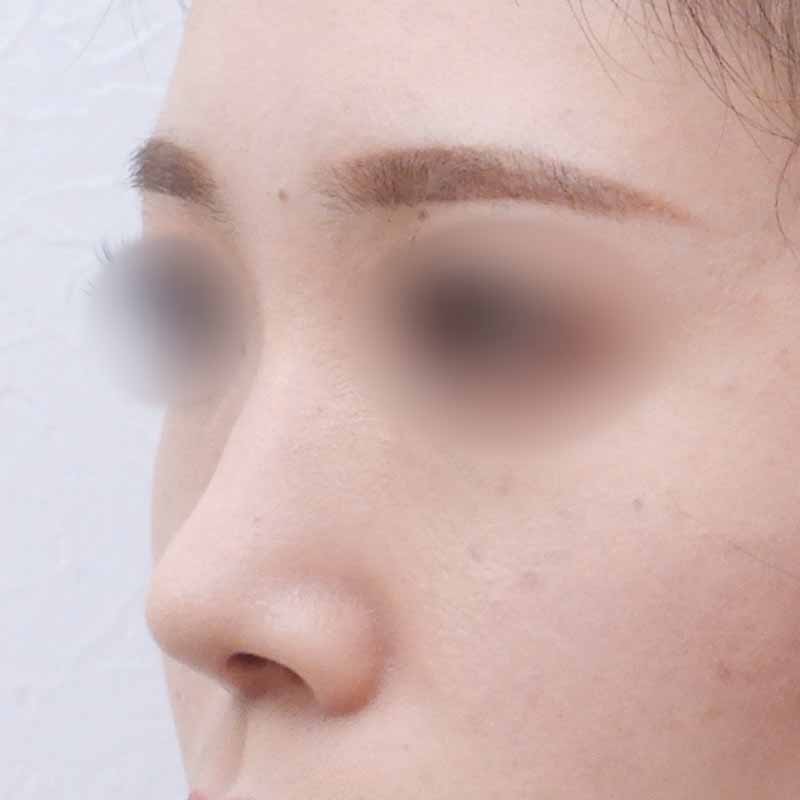 20240222_N20596_nishikawa_nose tip reduction-auricular cartilage 追加写真①After