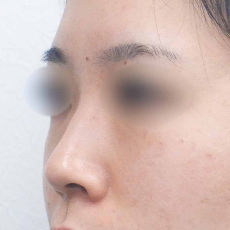 20240222_N20596_nishikawa_nose tip reduction-auricular cartilage 追加写真①Before