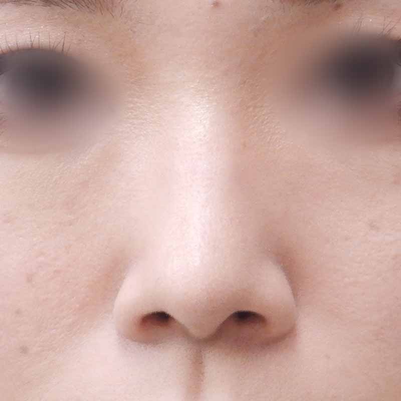 20240222_N20596_nishikawa_nose tip reduction-auricular cartilage 追加写真②After