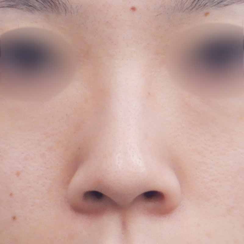 20240222_N20596_nishikawa_nose tip reduction-auricular cartilage 追加写真②Before