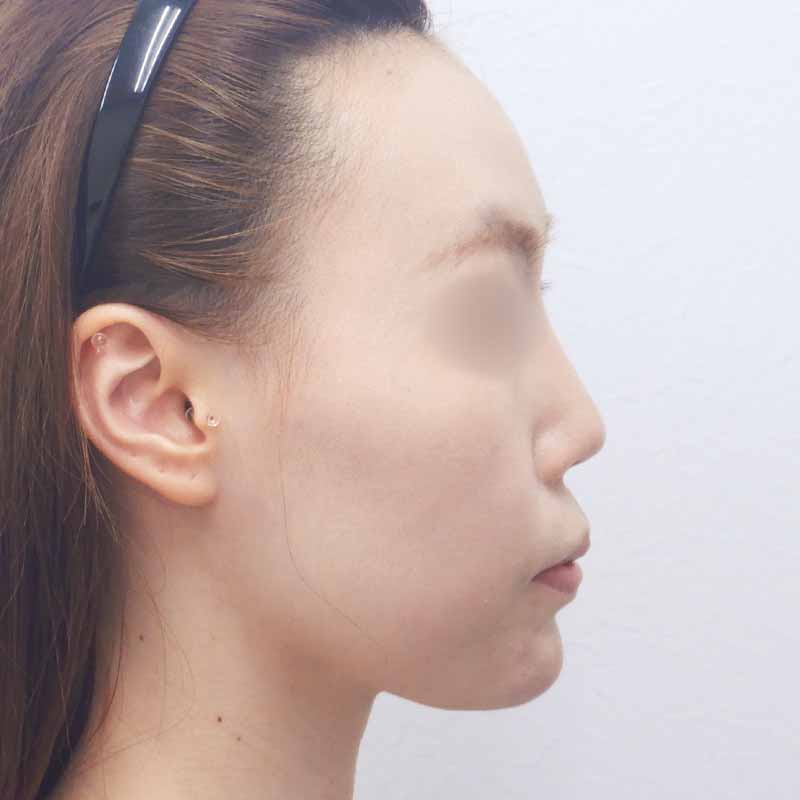 20240222_N28587_nishikawa_nose tip reduction-auricular cartilage 追加写真①After