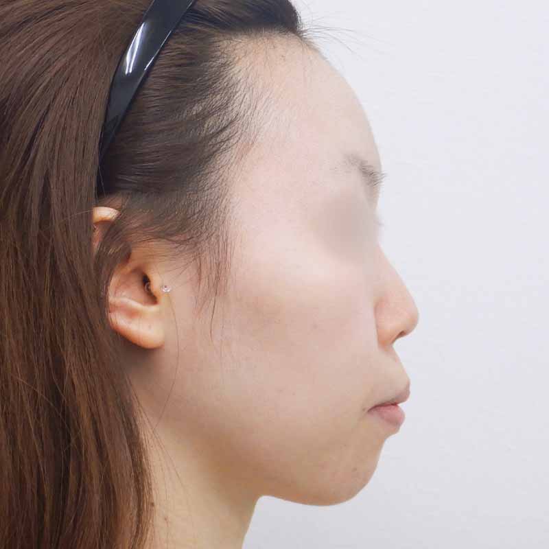 20240222_N28587_nishikawa_nose tip reduction-auricular cartilage 追加写真①Before