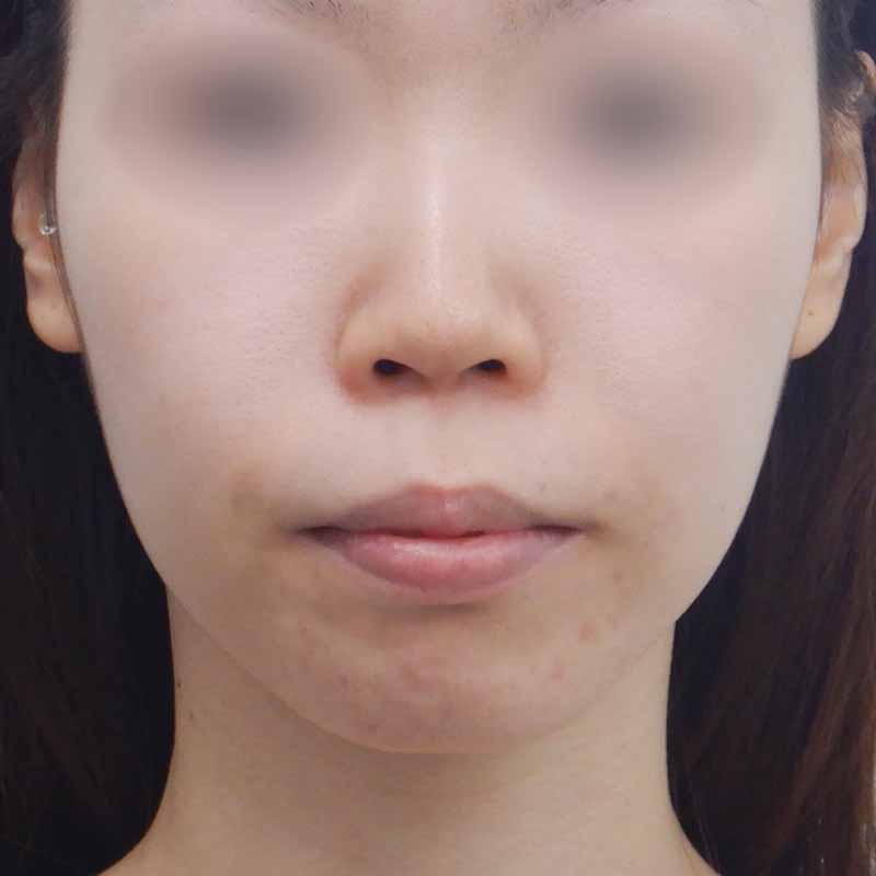 20240222_N28587_nishikawa_nose tip reduction-auricular cartilage 追加写真②Before