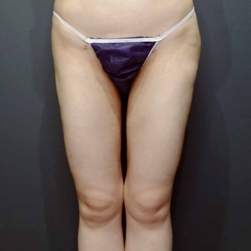 20240222_N32146_takemura_thigh-liposuction①After