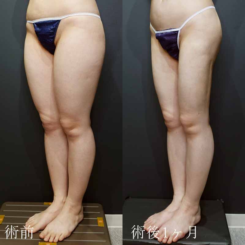 20240222_N32146_takemura_thigh-liposuction縦
