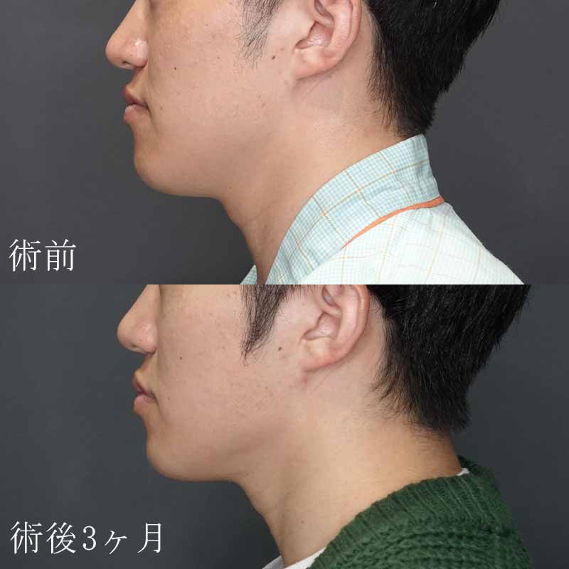 20240223_G33192_face-liposuction_masseter-muscle-botox