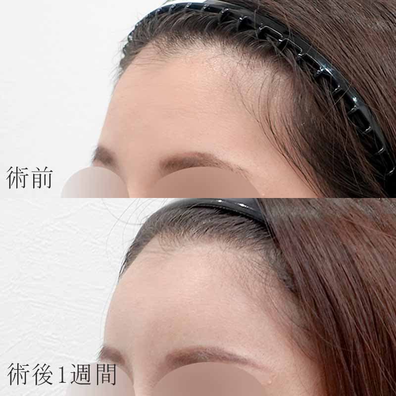 20240223_N26885_nakamura_hyaluronic forehead01