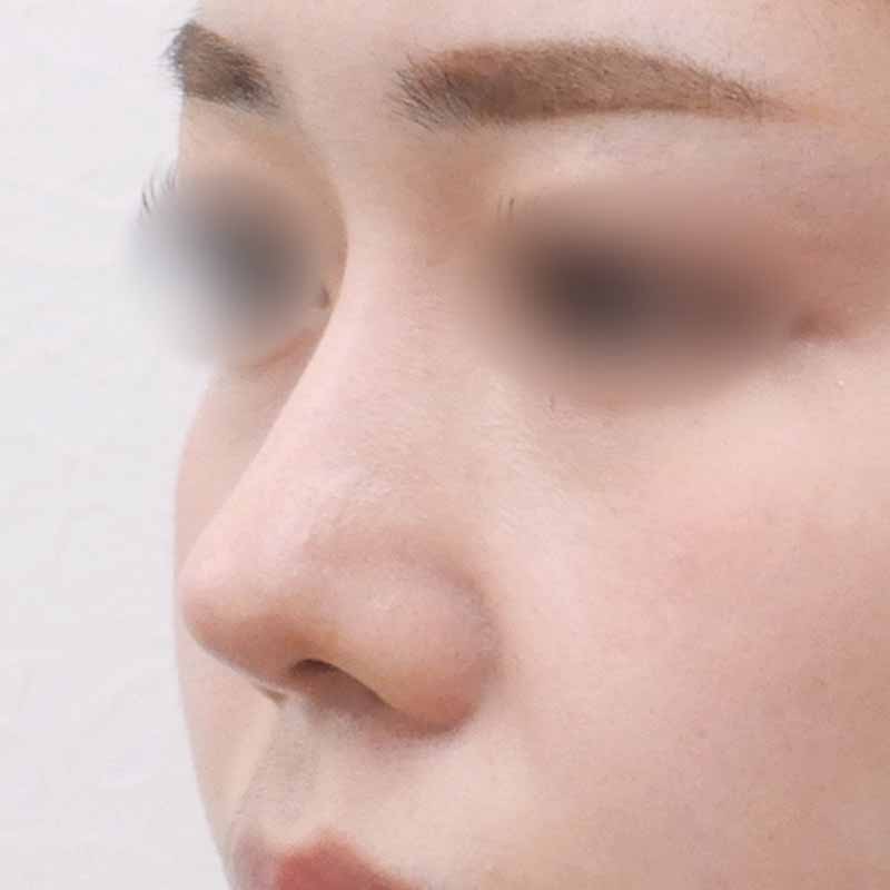 20240227_N32483_nishikawa-nose tip reduction-auricular cartilage追加写真①After