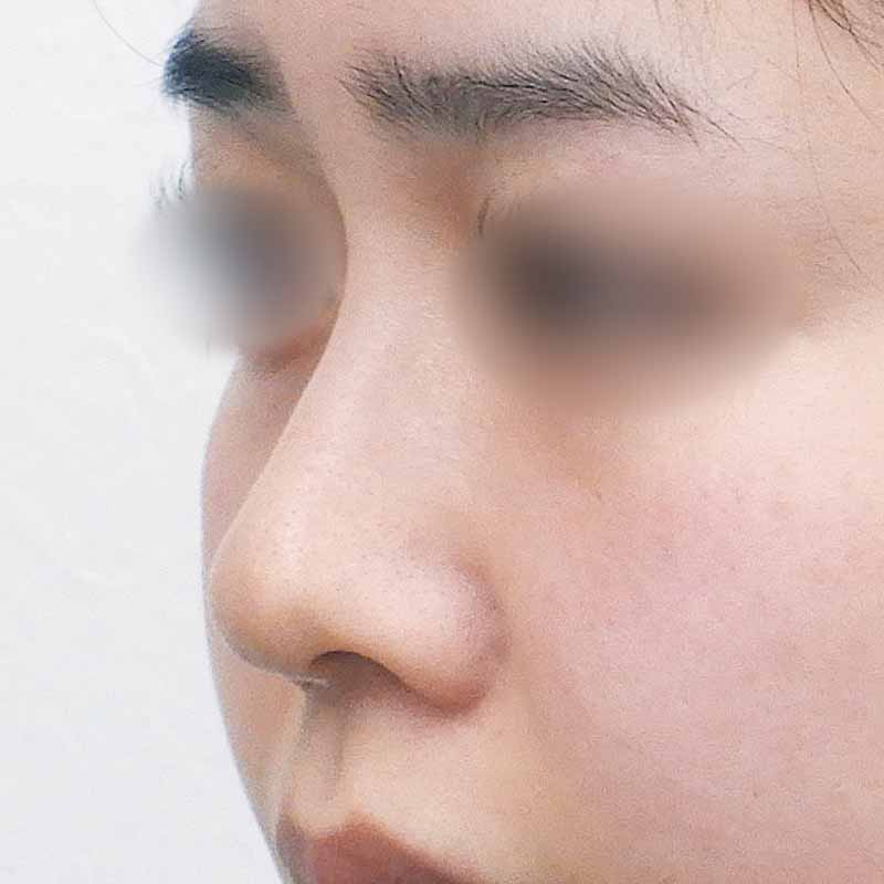 20240227_N32483_nishikawa-nose tip reduction-auricular cartilage追加写真①Before