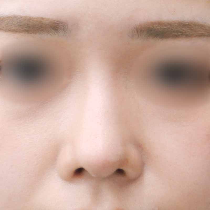 20240227_N32483_nishikawa-nose tip reduction-auricular cartilage追加写真②After