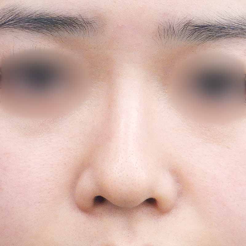 20240227_N32483_nishikawa-nose tip reduction-auricular cartilage追加写真②Before