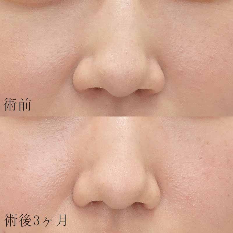 20240227_S0227_nishikawa-nostril reduction