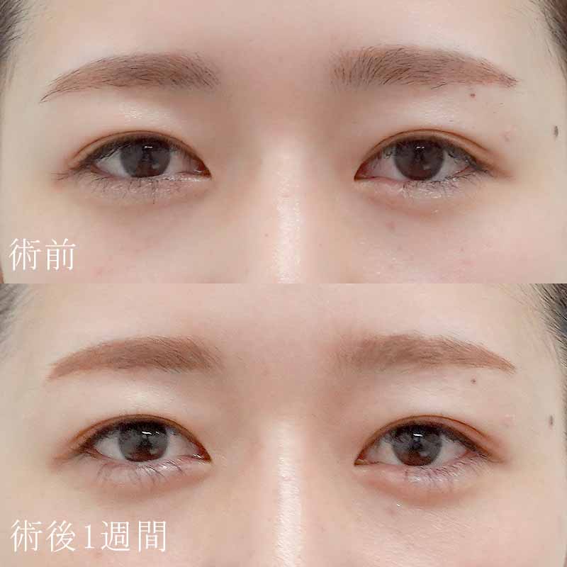 20240227_okesimai_nagahama_hyaluronic eye bags01