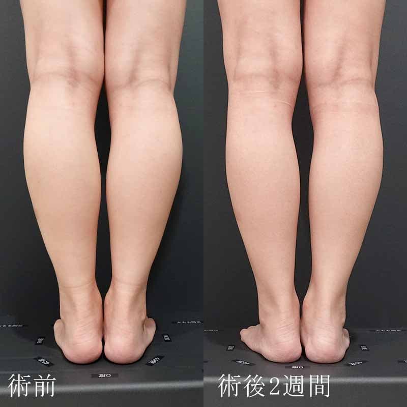 20240227_sasaki_tanaka_lower leg-botox01
