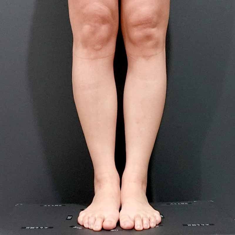 ふくらはぎのボトックス注射の症例写真 Ι 執刀医：田中 邦和 Ι 美容整形なら水の森美容クリニック