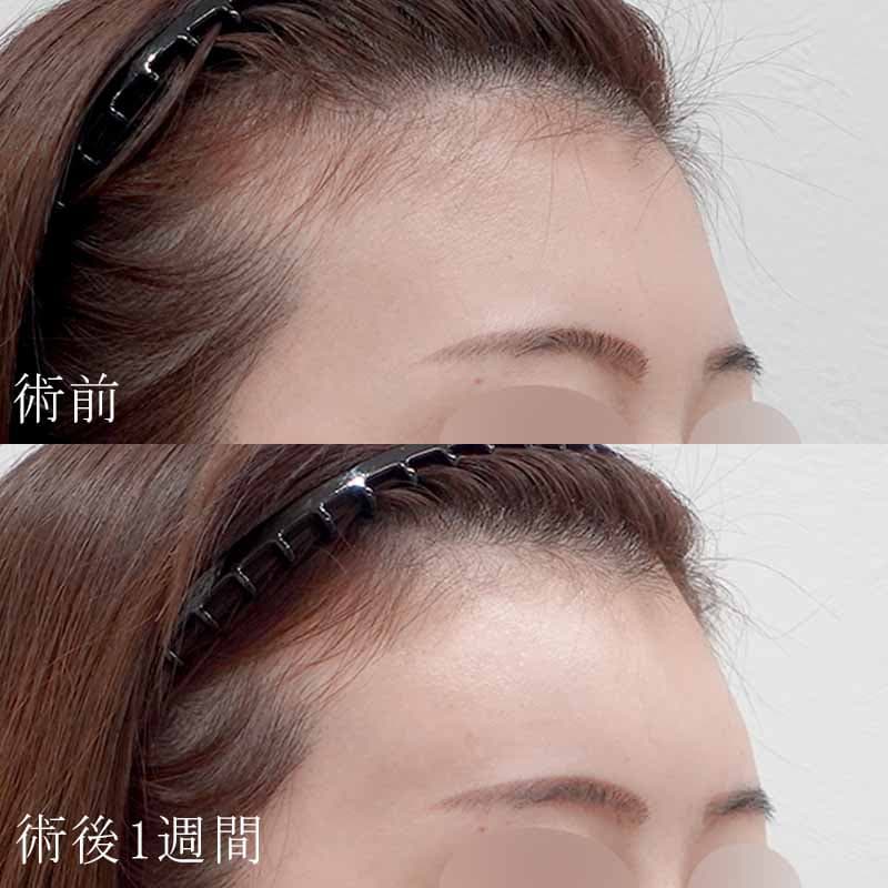 20240228_G22981_osada_hyaluronic forehead01