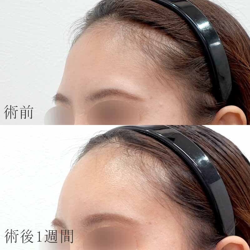 20240229_hino_osada_hyaluronic forehead01